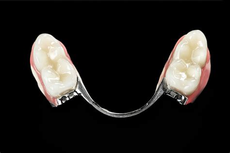 Vokiško kompozito dantų protezai