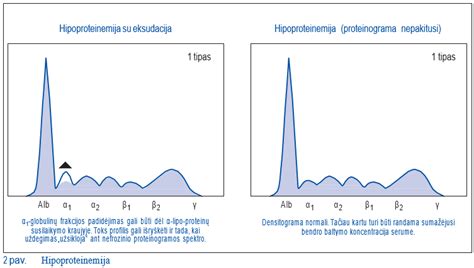 Nefrozinis spektras proteinogramoje