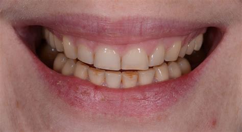 Prieš ir po: šypsenos atstatymas takiu kompozitu