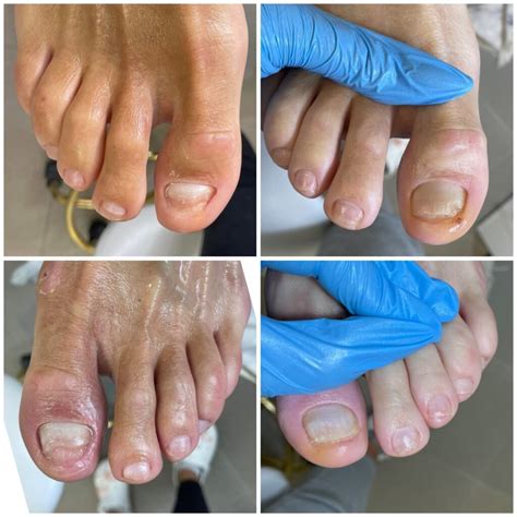 Nagų grybelio pažeisti nagai