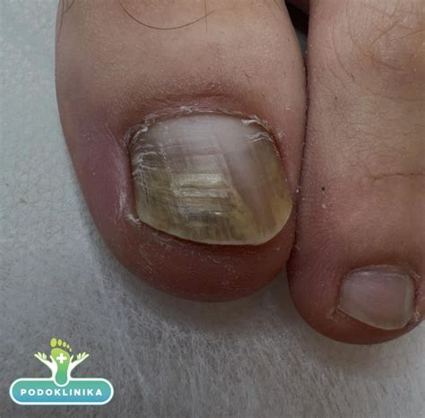 Pėdos ir nagų grybelio prevencija