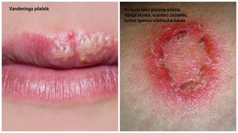 Herpes viruso pažeistos lūpos