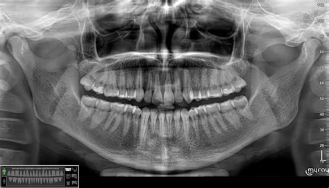 Rentgeno nuotrauka kaukolės lūžio