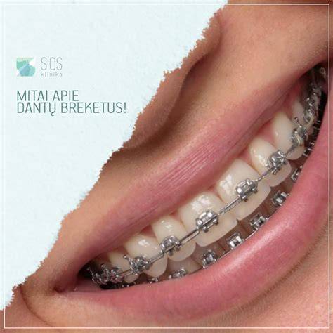 Infografika apie dantų plokštelių tipų palyginimą: dalinės vs. pilnos, metalinės vs. termoplastinės