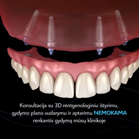 Kompaktiški ir anatominiai implantai: skirtumai vizualiai
