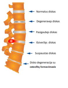 Infografika: Užpakalinės fiksavimo konstrukcijos palyginimas su tradicinėmis tarpslankstelinio disko implantų sistemomis