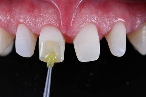Selective adhesive luting infographic: proceso schema ir privalumai