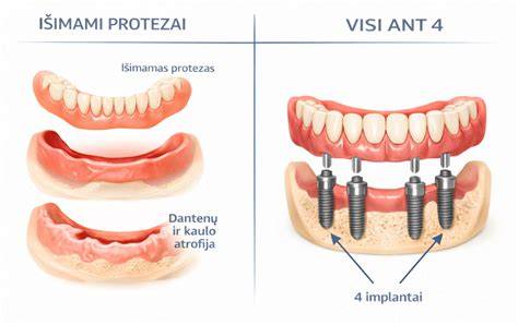 Infografika: išimamų ir fiksuotų protezų priežiūros pagrindai