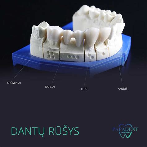 Infografika: dantų plokštelių tipai ir jų pritaikymo nuostatos