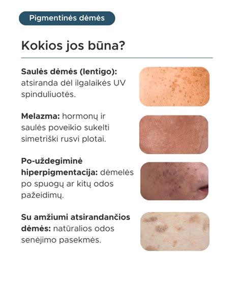 Žvynelinės paveikslėlis: odos dėmės ir pleiskanojimas