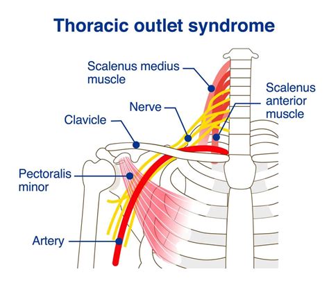Thoracic outlet sindromo paveikslėlis su paaiškinimais, kur vyksta spaudimas
