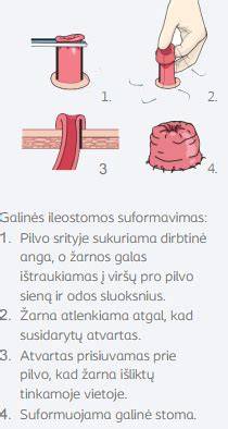 Infografika: kaip veikia tiesiosios žarnos vamzdelio drenažas