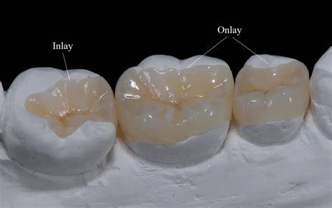 Inlay vs Onlay: skirtumai ir taikymas