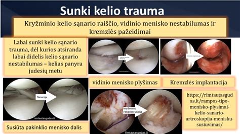 Infografika: Kaulų lūžių tipai ir gijimo etapai